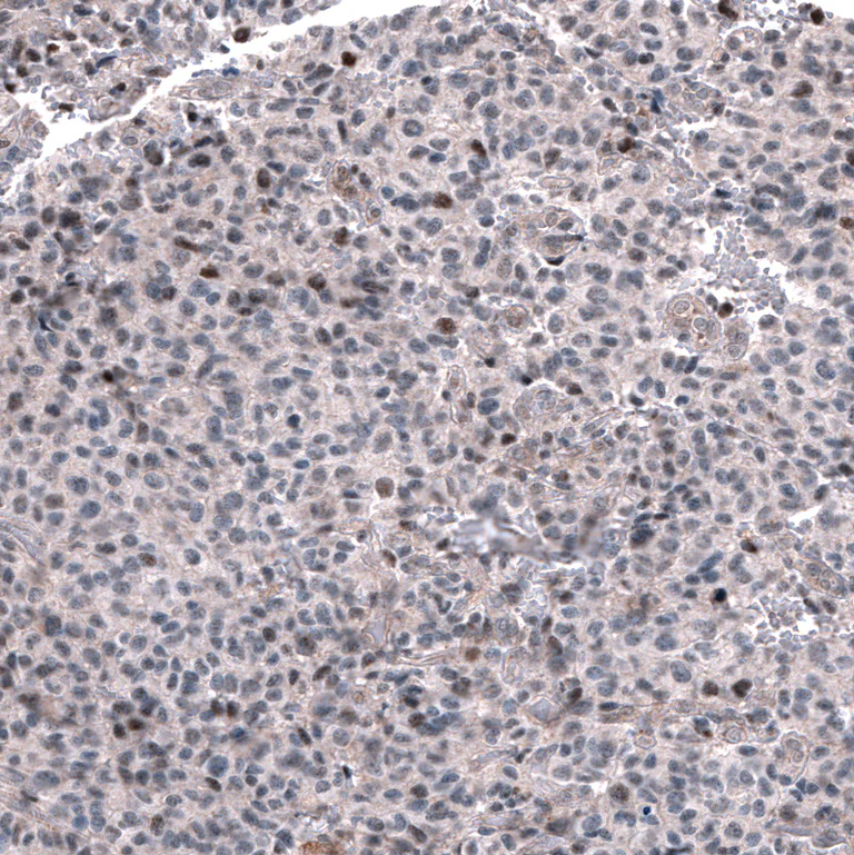 Immunohistochemistry (Formalin/PFA-fixed paraffin-embedded sections) - Anti-GLI1 Antibody [CL12193] (AB327139)