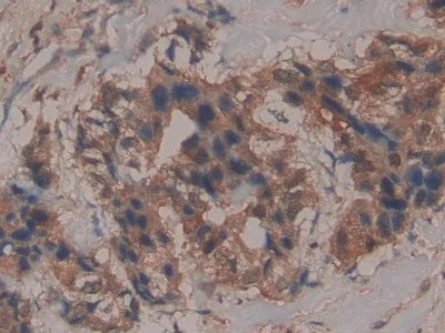 glutathione breast cancer Anti-Glutathione Peroxidase 4 antibody (ab231174)