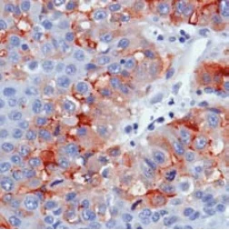 Immunohistochemistry (Formalin/PFA-fixed paraffin-embedded sections) - Anti-Glypican 3 antibody [SP86] - BSA and Azide free (AB238804)