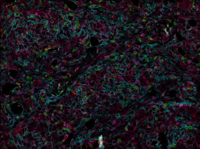 Multiplex immunohistochemistry - Anti-Granzyme B antibody [EPR20129-217] (ab208586), expandable thumbnail