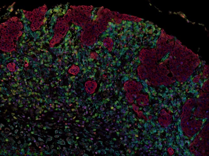 Multiplex immunohistochemistry - Anti-Granzyme B antibody [EPR20129-217] (ab208586), expandable thumbnail