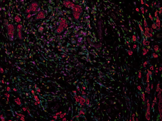 Multiplex immunohistochemistry - Anti-Granzyme B antibody [EPR20129-217] (ab208586), expandable thumbnail