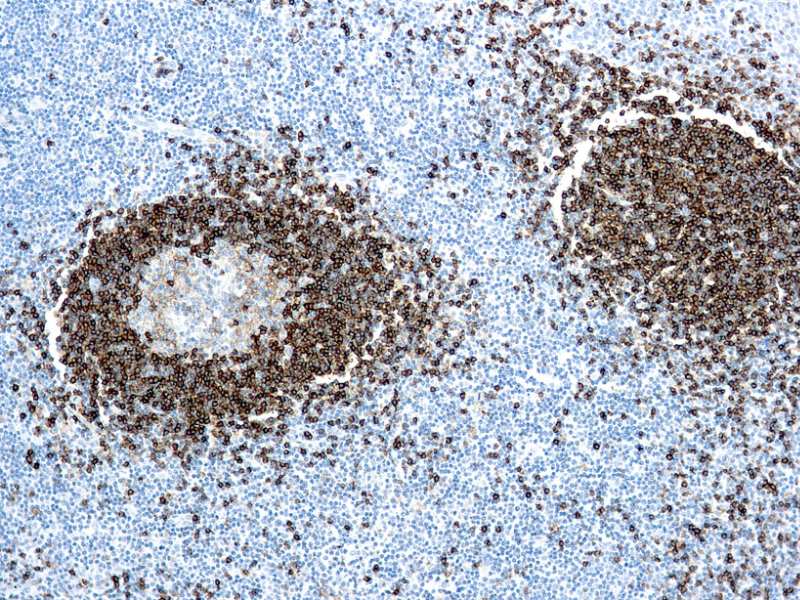Immunohistochemistry (Formalin/PFA-fixed paraffin-embedded sections) - Anti-Hairy Cell Leukemia antibody [DBA.44], prediluted (AB857)