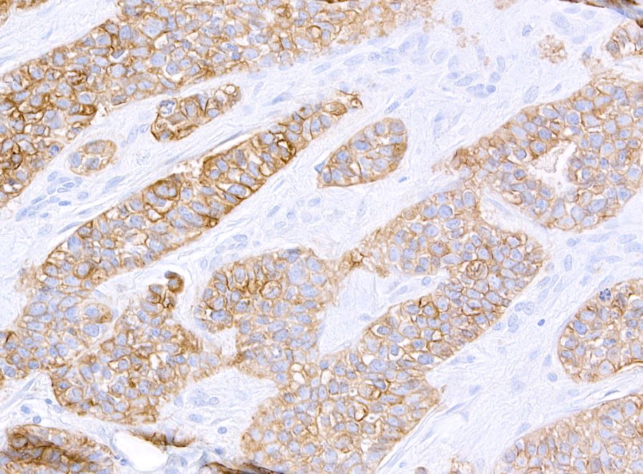 Immunohistochemistry (Formalin/PFA-fixed paraffin-embedded sections) - Anti-HER2/ErbB2 antibody [BLR241L] - BSA free (AB314070), expandable thumbnail