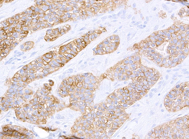 Immunohistochemistry (Formalin/PFA-fixed paraffin-embedded sections) - Anti-HER2/ErbB2 antibody [BLR241L] - BSA free (AB314070)