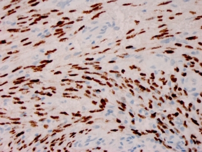 Immunohistochemistry (Formalin/PFA-fixed paraffin-embedded sections) - Anti-HHV8 antibody [HHV8/3606] - BSA and Azide free (AB267355)