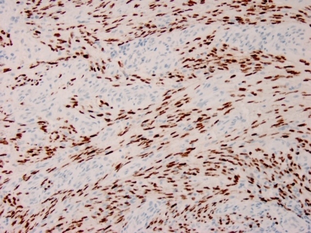 Immunohistochemistry (Formalin/PFA-fixed paraffin-embedded sections) - Anti-HHV8 antibody [HHV8/3633R] (AB267352)
