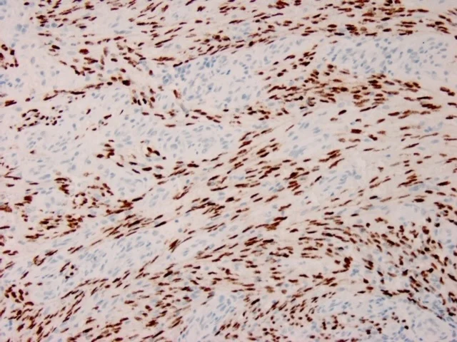 Immunohistochemistry (Formalin/PFA-fixed paraffin-embedded sections) - Anti-HHV8 antibody [HHV8/3633R] (AB267352)
