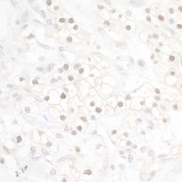 Immunohistochemistry (Formalin/PFA-fixed paraffin-embedded sections) - Anti-HIF-1 alpha antibody [BL-124-3F7] - BSA free (AB272040), expandable thumbnail