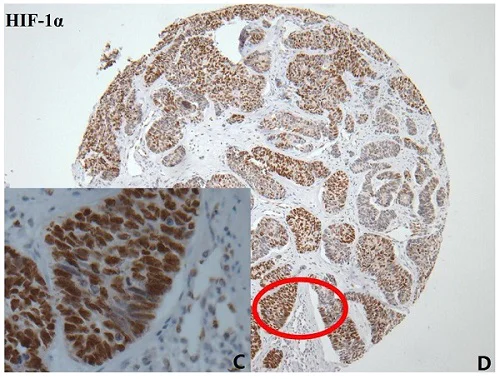 Immunohistochemistry (Formalin/PFA-fixed paraffin-embedded sections) - Anti-HIF-1 alpha antibody [EP1215Y] - BSA and Azide free (AB210073)