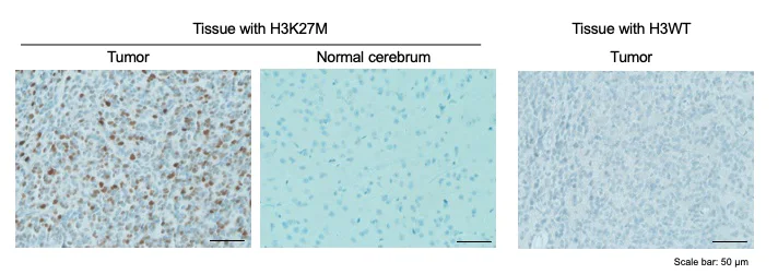 Immunohistochemistry (Formalin/PFA-fixed paraffin-embedded sections) - Anti-Histone H3 (mutated K27M) antibody [EPR18340] - ChIP Grade (AB190631)