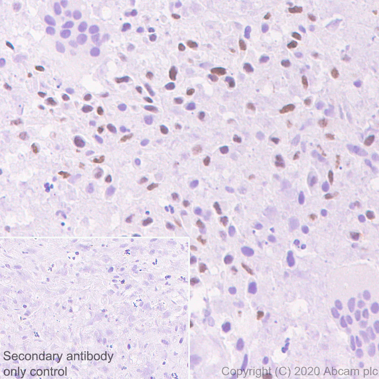 Immunohistochemistry (Formalin/PFA-fixed paraffin-embedded sections) - Anti-Histone H3.3 (mutated G34R) antibody [EPR23519-91] - ChIP Grade - BSA and Azide free (AB273635)