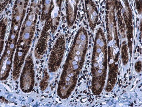 Immunohistochemistry (Formalin/PFA-fixed paraffin-embedded sections) - Anti-HMGA2 antibody (ab97276), expandable thumbnail