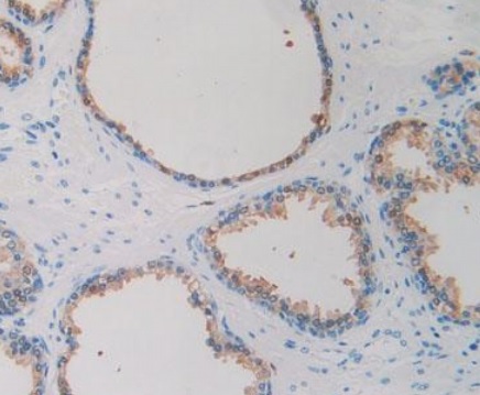 Immunohistochemistry (Formalin/PFA-fixed paraffin-embedded sections) - Anti-IDH1 antibody [C12] (AB239606), expandable thumbnail