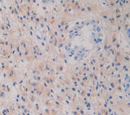 Immunohistochemistry (Formalin/PFA-fixed paraffin-embedded sections) - Anti-IDH1 antibody [C12] (AB239606), expandable thumbnail