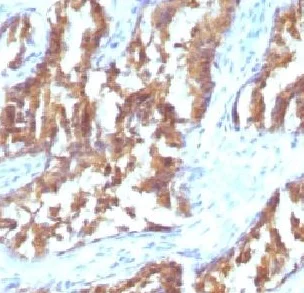 Immunohistochemistry (Formalin/PFA-fixed paraffin-embedded sections) - Anti-IDH1 antibody [IDH1/1152] (AB215829)