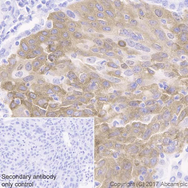 Immunohistochemistry (Formalin/PFA-fixed paraffin-embedded sections) - Anti-IGF2BP1/IMP1 antibody [EPR18791] (AB184305), expandable thumbnail