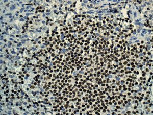 Immunohistochemistry (Formalin/PFA-fixed paraffin-embedded sections) - Anti-IKZF3 antibody [EPR9342(B)] (ab139408), expandable thumbnail