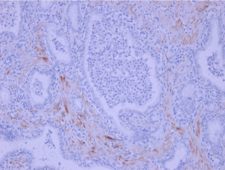 Immunohistochemistry (Formalin/PFA-fixed paraffin-embedded sections) - Anti-IL-6 antibody [1.2-2B11-2G10] (AB9324), expandable thumbnail