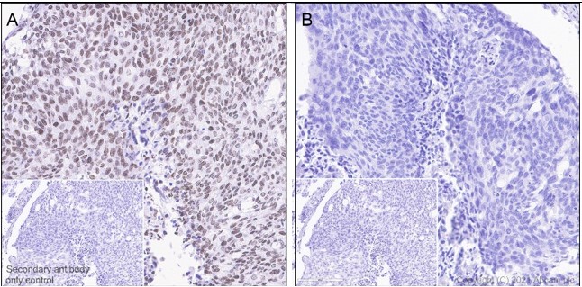 Immunohistochemistry (Formalin/PFA-fixed paraffin-embedded sections) - Anti-JAK2 (phospho Y1007 + Y1008) + JAK1 (phospho Y1034 + Y1035) antibody [E132] (AB32101), expandable thumbnail