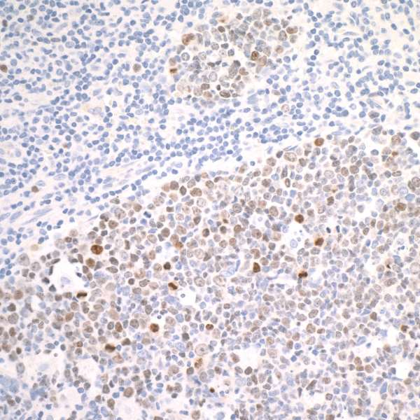Immunohistochemistry (Formalin/PFA-fixed paraffin-embedded sections) - Anti-Ki67 antibody [BLR021E] - BSA free (AB272075), expandable thumbnail