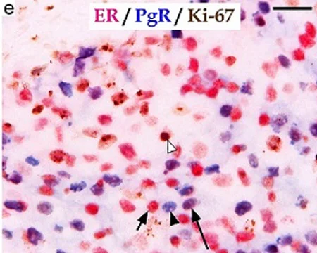 Immunohistochemistry (Formalin/PFA-fixed paraffin-embedded sections) - Anti-Ki67 antibody [EPR3610] (AB92742)