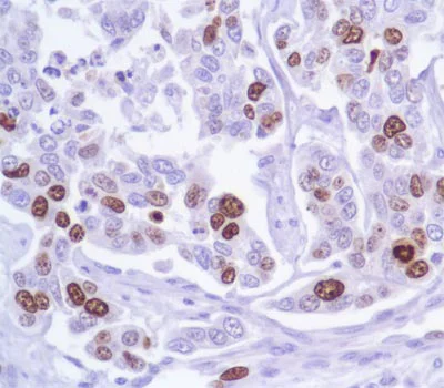 Immunohistochemistry (Formalin/PFA-fixed paraffin-embedded sections) - Anti-Ki67 antibody [SP6], prediluted (AB21700)