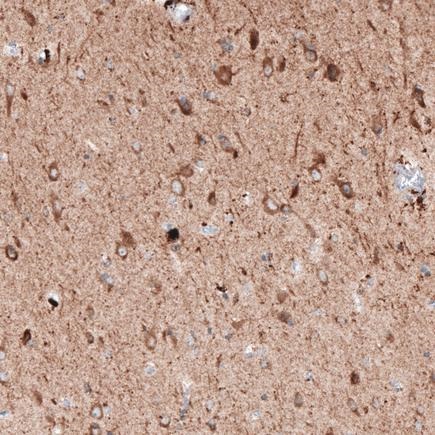 Immunohistochemistry (Formalin/PFA-fixed paraffin-embedded sections) - Anti-LAPTM4B antibody [CL5289] (AB242376), expandable thumbnail