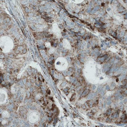 Immunohistochemistry (Formalin/PFA-fixed paraffin-embedded sections) - Anti-MACC1 antibody [CL0856] (ab242199), expandable thumbnail