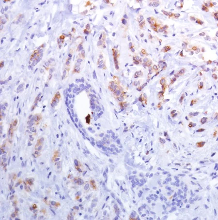 Immunohistochemistry (Formalin/PFA-fixed paraffin-embedded sections) - Anti-Mammaglobin A antibody [SP319] - C-terminal (AB223504)