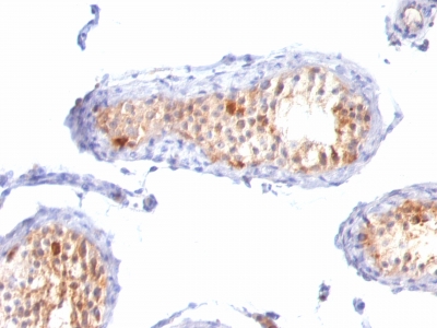 Immunohistochemistry (Formalin/PFA-fixed paraffin-embedded sections) - Anti-MelanA antibody [A103 + M2-7C10 + M2-9E3] - BSA and Azide free (AB212366), expandable thumbnail