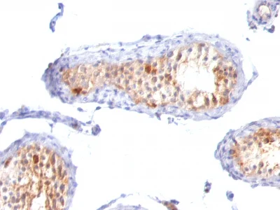 Immunohistochemistry (Formalin/PFA-fixed paraffin-embedded sections) - Anti-MelanA antibody [A103 + M2-7C10 + M2-9E3] - BSA and Azide free (AB212366)