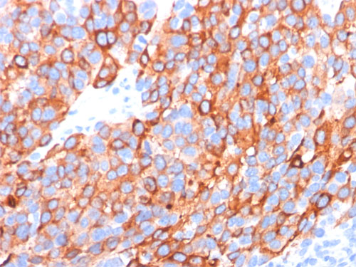 Immunohistochemistry (Formalin/PFA-fixed paraffin-embedded sections) - Anti-MelanA antibody [A103-M27C10-M29E3] (AB200544), expandable thumbnail