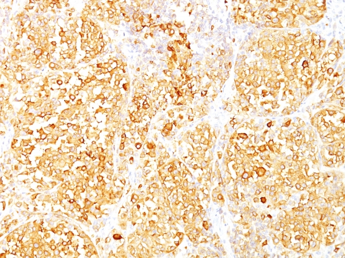 Immunohistochemistry (Formalin/PFA-fixed paraffin-embedded sections) - Anti-MelanA antibody [M2-9E3] (AB187369), expandable thumbnail