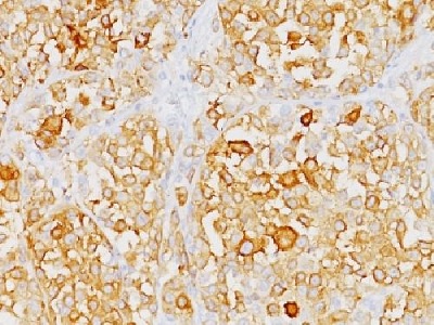 Immunohistochemistry (Formalin/PFA-fixed paraffin-embedded sections) - Anti-MelanA antibody [M2-9E3] - BSA and Azide free (AB212362), expandable thumbnail