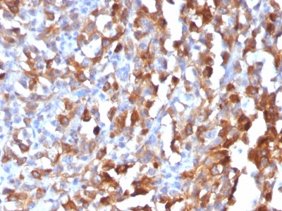 Immunohistochemistry (Formalin/PFA-fixed paraffin-embedded sections) - Anti-MelanA antibody [MLANA/1409R] (AB234416), expandable thumbnail