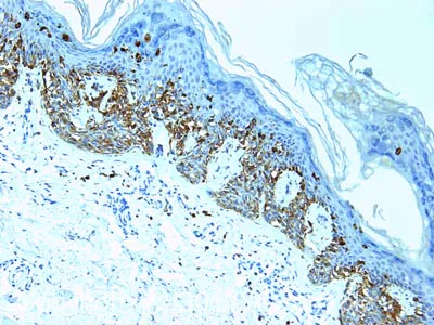Anti-Melanoma antibody [HMB45 + M2-7C10 + M2-9E3 + T311] (ab733) | Abcam