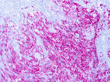 Immunohistochemistry (Formalin/PFA-fixed paraffin-embedded sections) - Anti-Melanoma antibody [PNL2] (AB12502)