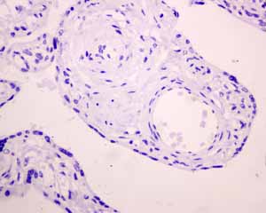 Immunohistochemistry (Formalin/PFA-fixed paraffin-embedded sections) - Anti-Melanoma gp100 antibody [EPR4864] (AB137062), expandable thumbnail