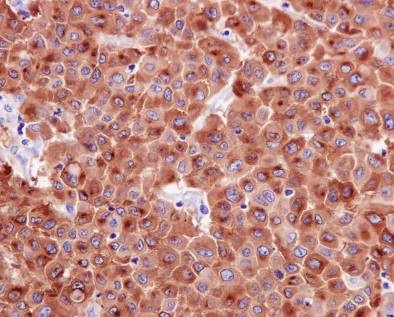 Immunohistochemistry (Formalin/PFA-fixed paraffin-embedded sections) - Anti-Melanoma gp100 antibody [EPR4864] (AB137062), expandable thumbnail