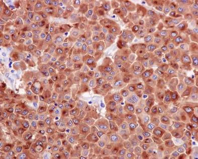 Immunohistochemistry (Formalin/PFA-fixed paraffin-embedded sections) - Anti-Melanoma gp100 antibody [EPR4864] - BSA and Azide free (AB190913)