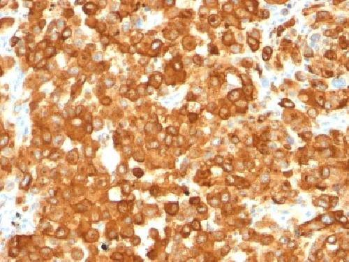 Immunohistochemistry (Formalin/PFA-fixed paraffin-embedded sections) - Anti-Melanoma gp100 antibody [HMB45] (AB787)
