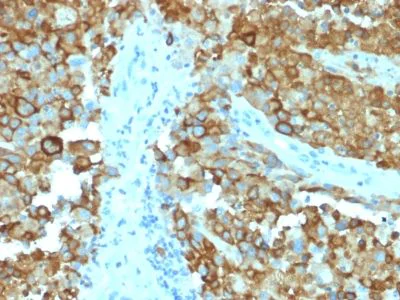 Immunohistochemistry (Formalin/PFA-fixed paraffin-embedded sections) - Anti-Melanoma gp100 antibody [PMEL/2038] - BSA and Azide free (AB237898)