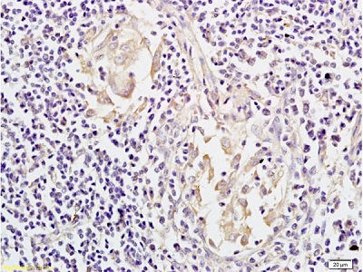 Immunohistochemistry (Formalin/PFA-fixed paraffin-embedded sections) - Anti-Mesothelin antibody (AB215438), expandable thumbnail