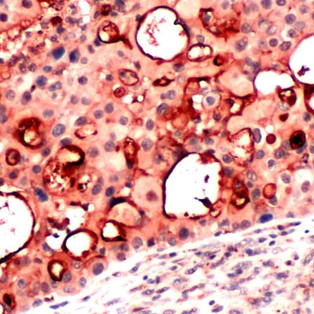 Immunohistochemistry (Formalin/PFA-fixed paraffin-embedded sections) - Anti-Mesothelin antibody (AB224730)