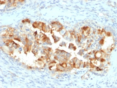 Immunohistochemistry (Formalin/PFA-fixed paraffin-embedded sections) - Anti-Mesothelin antibody [MSLN/2131] (AB236546)