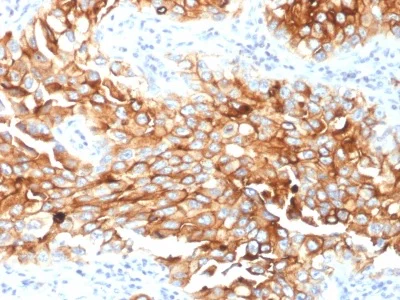 Immunohistochemistry (Formalin/PFA-fixed paraffin-embedded sections) - Anti-Mesothelin antibody [MSLN/2131] (AB236546)