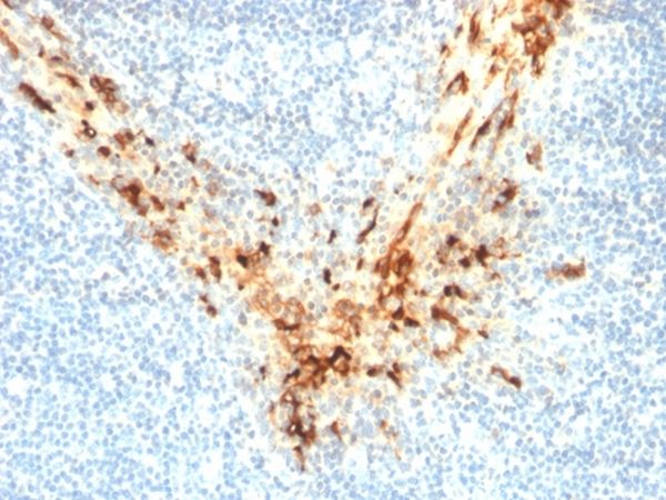 Immunohistochemistry (Formalin/PFA-fixed paraffin-embedded sections) - Anti-Mesothelin antibody [MSLN/2131] - BSA and Azide free (AB237817), expandable thumbnail
