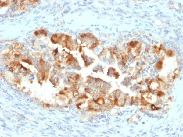 Immunohistochemistry (Formalin/PFA-fixed paraffin-embedded sections) - Anti-Mesothelin antibody [MSLN/2131] - BSA and Azide free (AB237817), expandable thumbnail