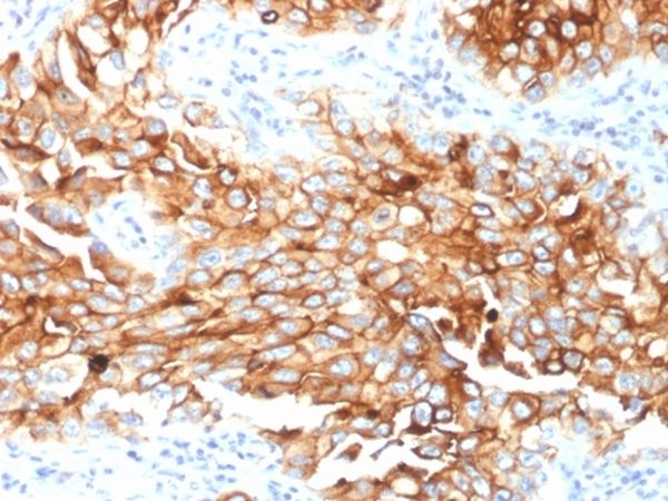 Immunohistochemistry (Formalin/PFA-fixed paraffin-embedded sections) - Anti-Mesothelin antibody [MSLN/2131] - BSA and Azide free (ab237817), expandable thumbnail